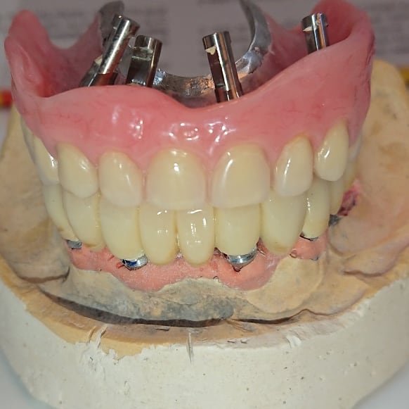 درمان بی دندانی کامل، با ایمپلنت های دندانی