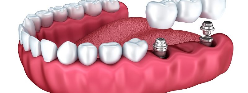 ایمپلنت و بریج دندان برای چه کسانی مناسب است؟