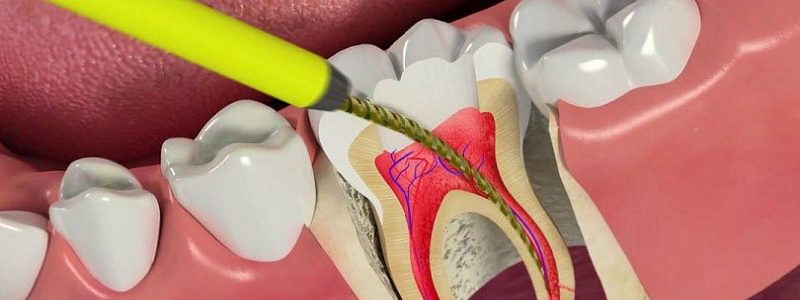 آیا درمان جایگزینی بجای عصب کشی دندان وجود دارد؟