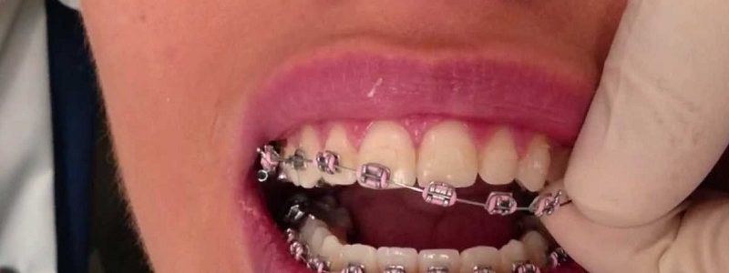 آیا براکت ارتودنسی دندانها را لک می کند؟