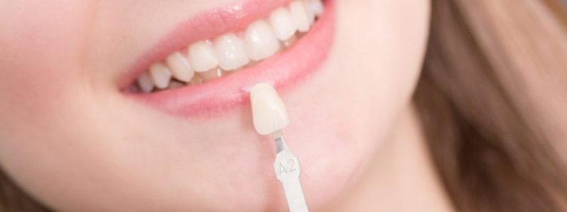 بررسی انواع روکش های دندان