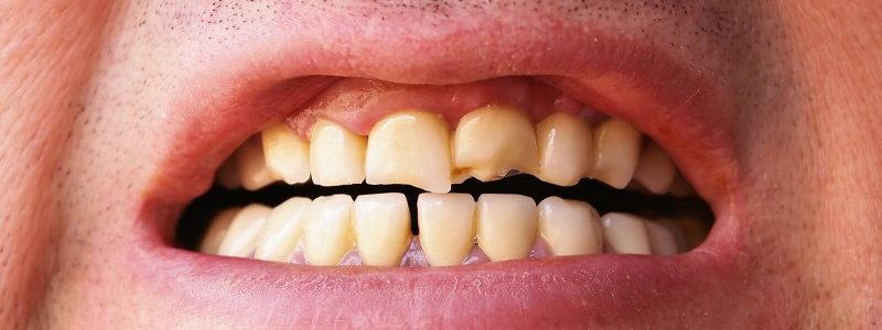 درمان تیزی دندان