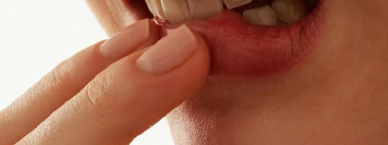 درمان آفت دهان چیست؟