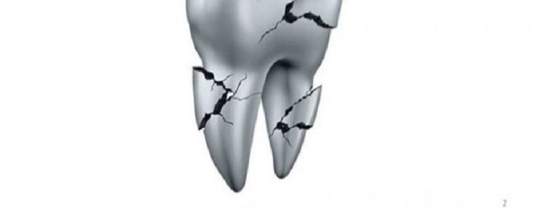 شکستگی ریشه دندان چگونه رخ می دهد؟
