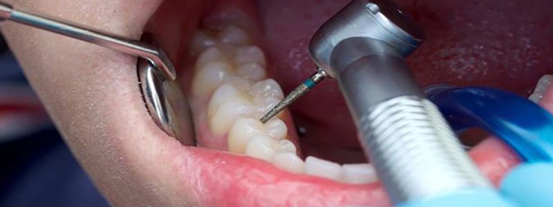 عصب کشی دندان چگونه انجام می‌شود ؟