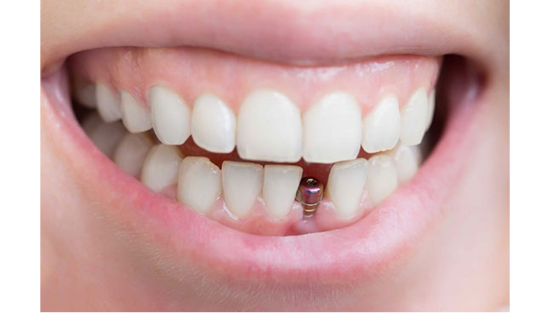 شناسایی معایب و مزایای کاشت ایمپلنت دندان | دندانپزشک متخصص اصفهان