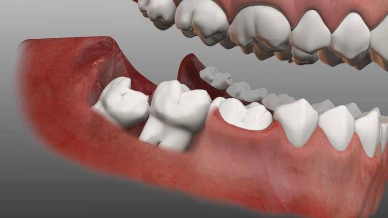 پری کورونیت دندان چیست؟
